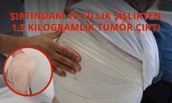 Sırtındaki 10 Yıllık Şişlikten 1.5 Kilogramlık Tümör Çıktı