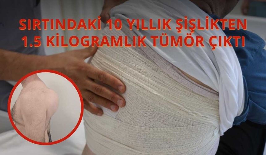 Sırtındaki 10 Yıllık Şişlikten 1.5 Kilogramlık Tümör Çıktı