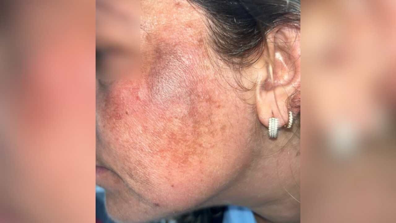 Adana'da Güzellik Merkezi Faciası Prenses Cilt Bakımı Yüzünden 2. Derece Yanık Oluştu (1)