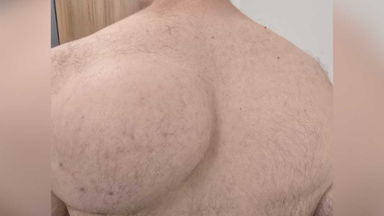 Sırtındaki 10 Yıllık Şişlikten 1.5 Kilogramlık Tümör Çıktı (2)