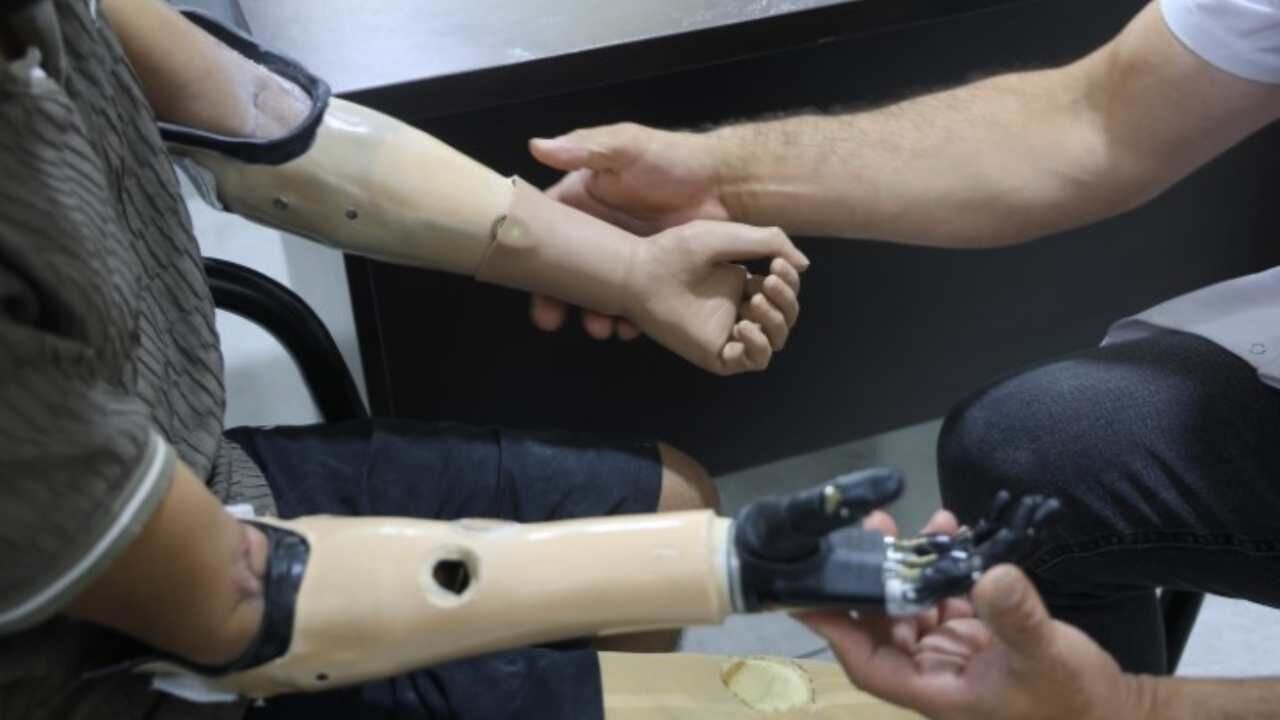 Elektrik Kazası Sonrası Biyonik Kollarına Kavuştu (3)